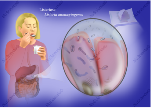 Listeriosis and Listeria Life Cycle